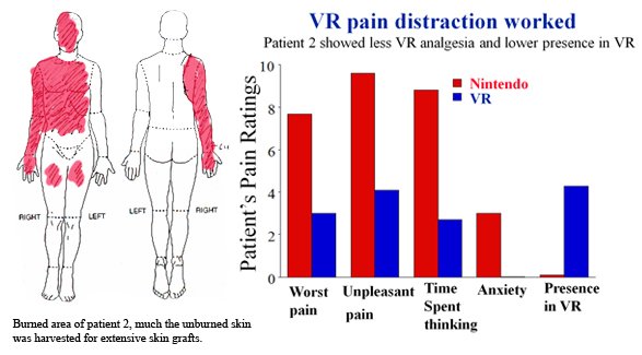 VR for pain distraction