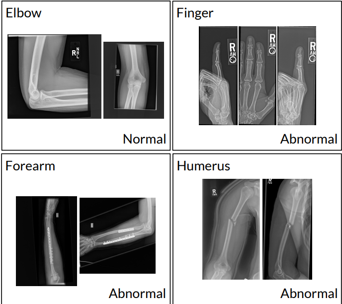 X-rays of upper extremities labeled as normal or abnormal